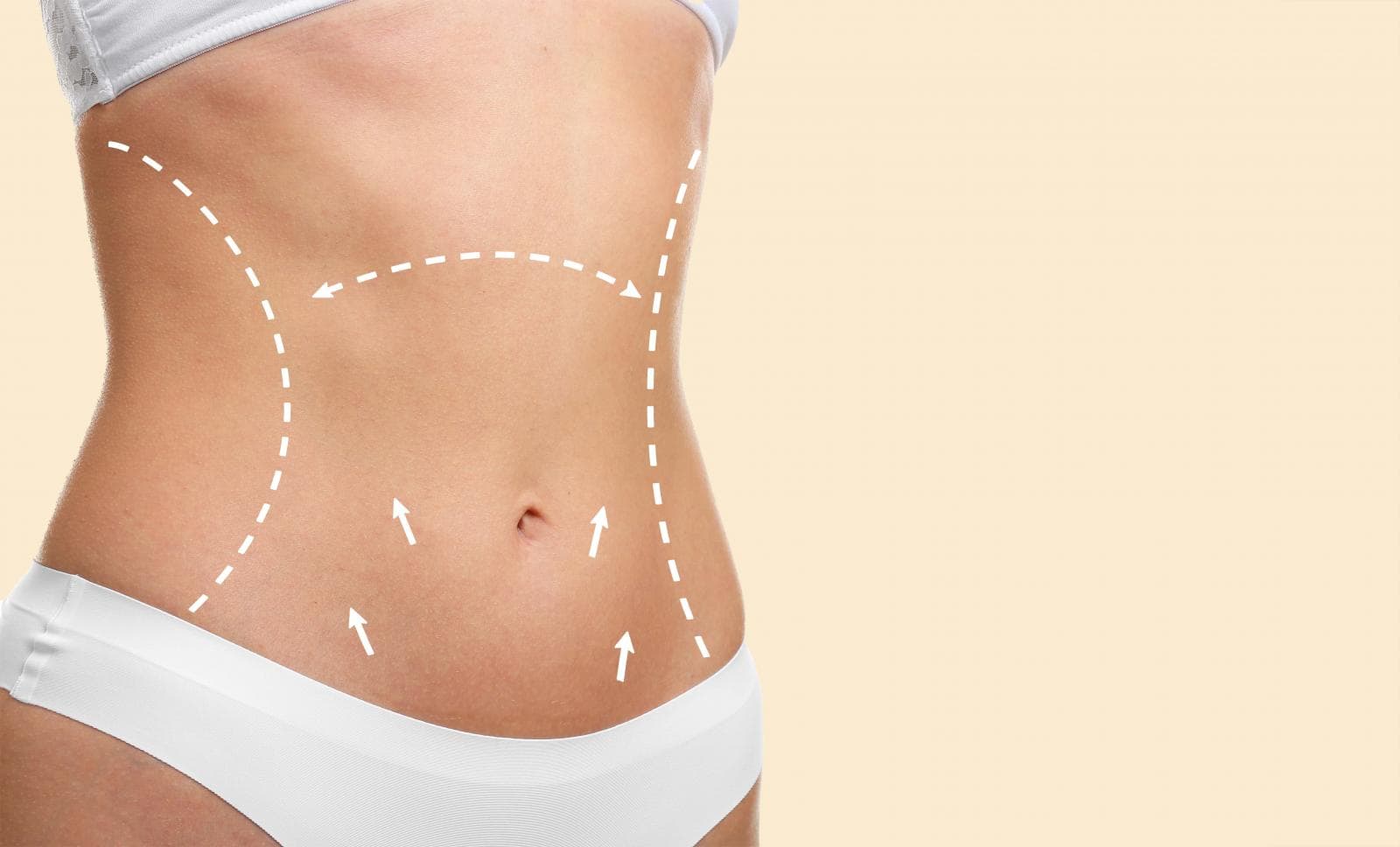 Abdominoplastia