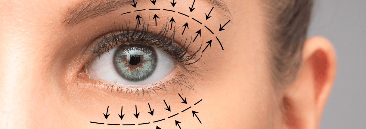 Blefaroplastia