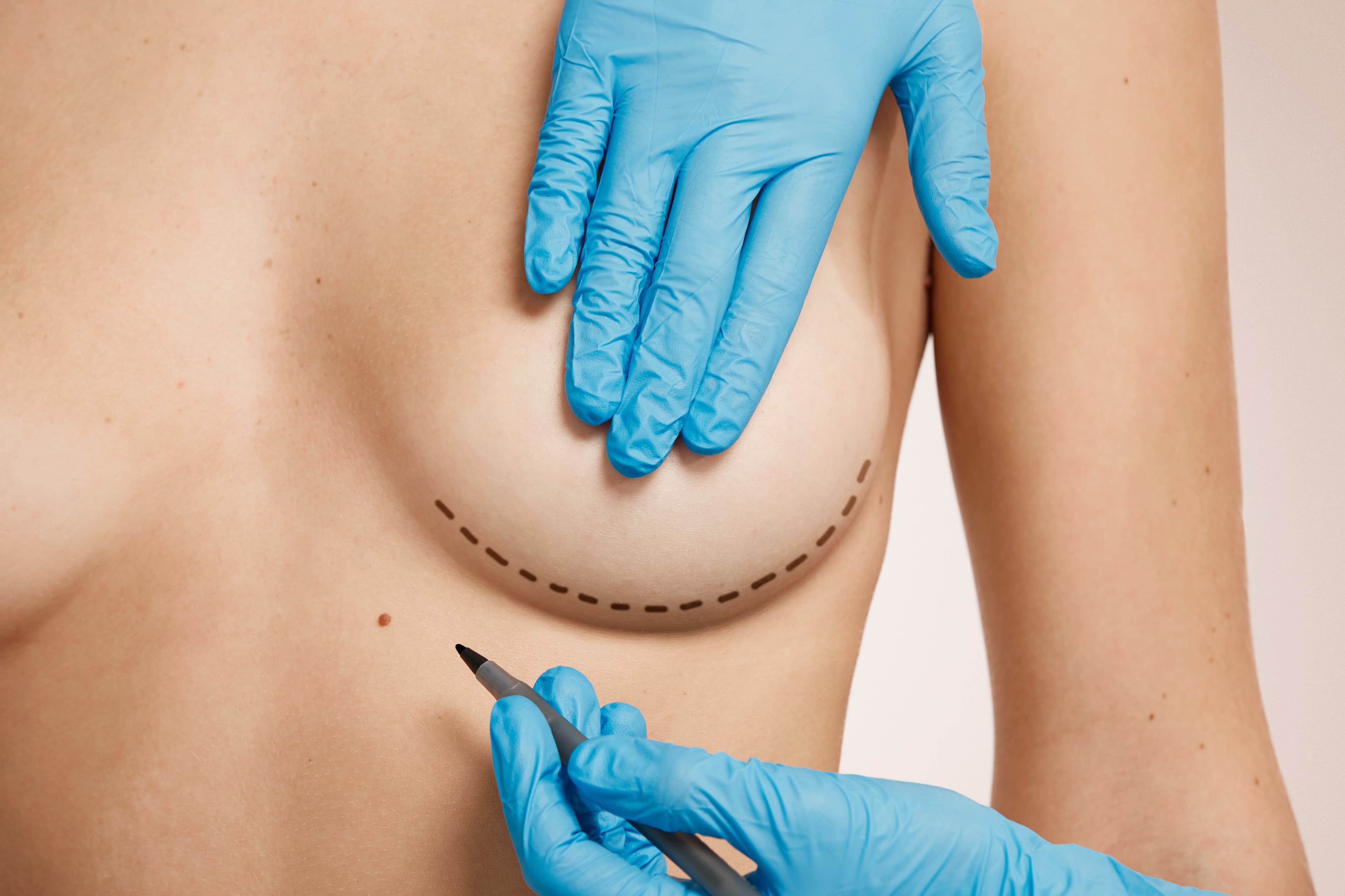 Mamoplastia Redutora