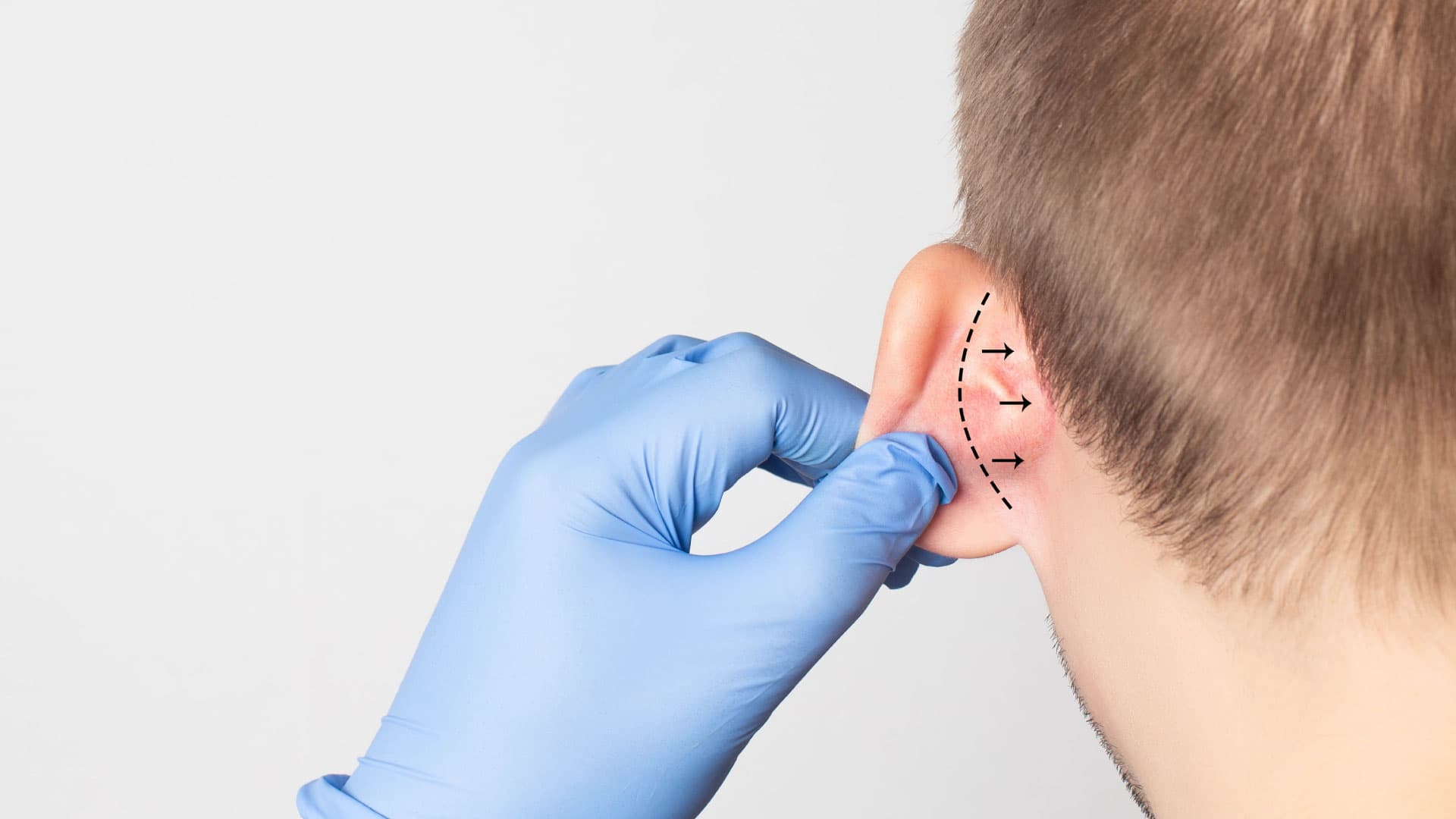 Otoplastia e Lobuloplastia